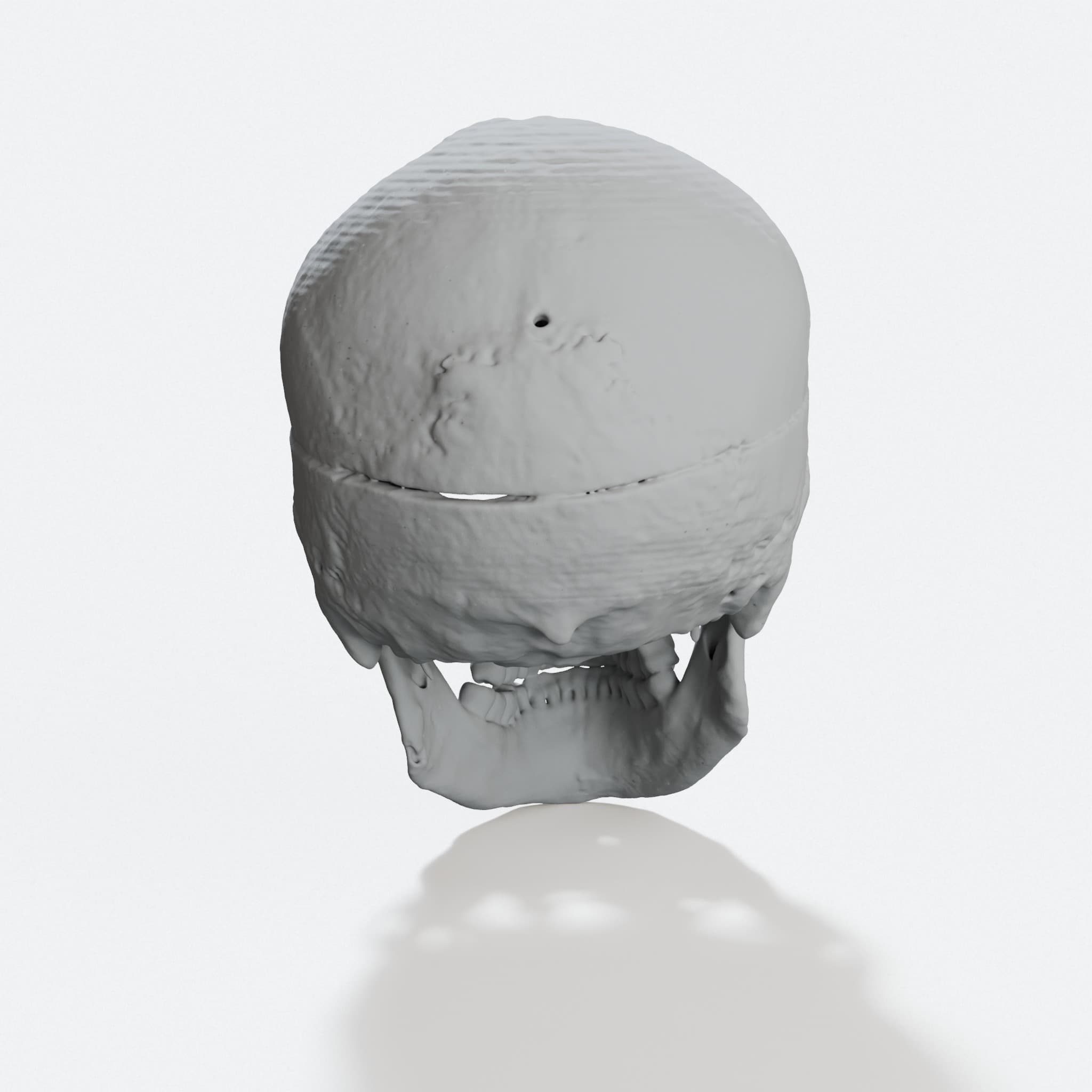 Skull of Phineas Gage - Educational Anatomical Model